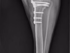 Securos TPLO Plate